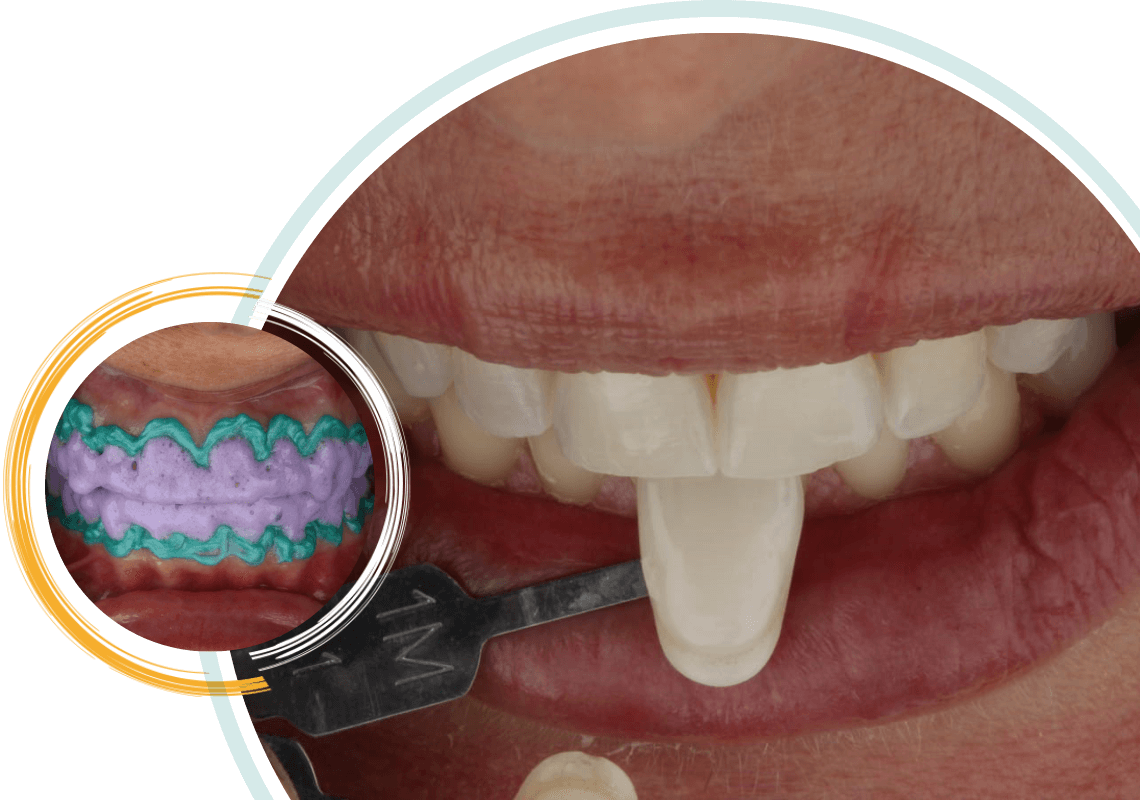 clareamento-dental-em-salvador