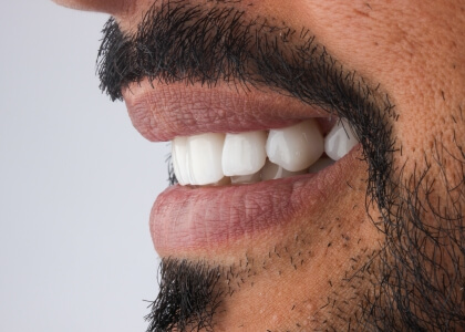Lente de contato dental em Salvador
