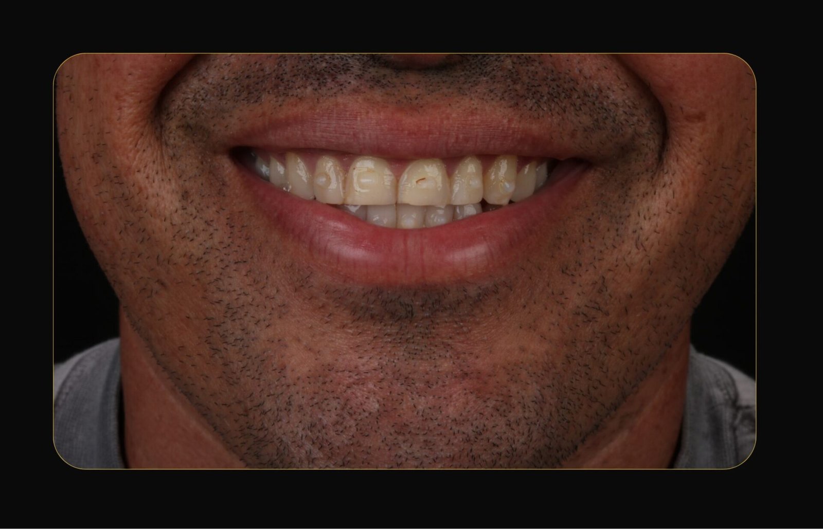 DR CLOVIS ANTES E DEPOIS (8)
